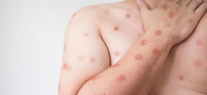 SES alerta para monitoramento de casos de Mpox em MT ap&oacute;s avan&ccedil;o de variante em Rond&ocirc;nia